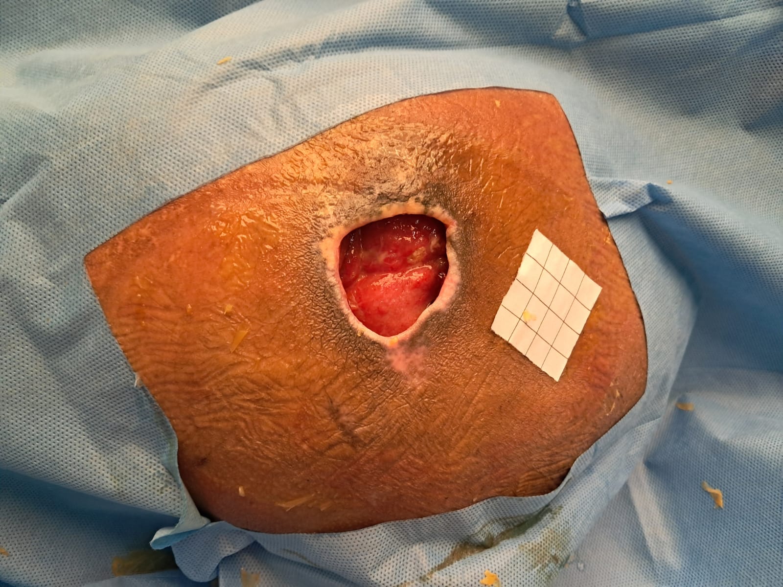 Application of Prolotherapy for Pressure Injury